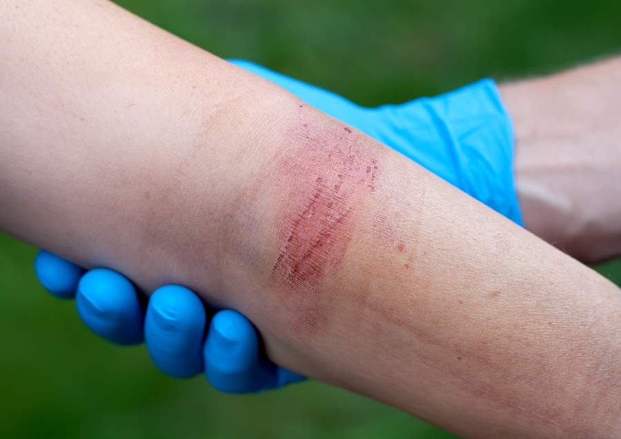 Types of Burn Injuries and How They Happen